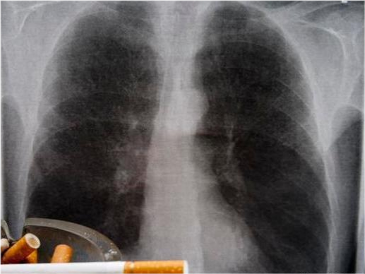 的吸烟者肺癌通常是黑色的,和癌症的机率比不抽烟的人高不知道多少次