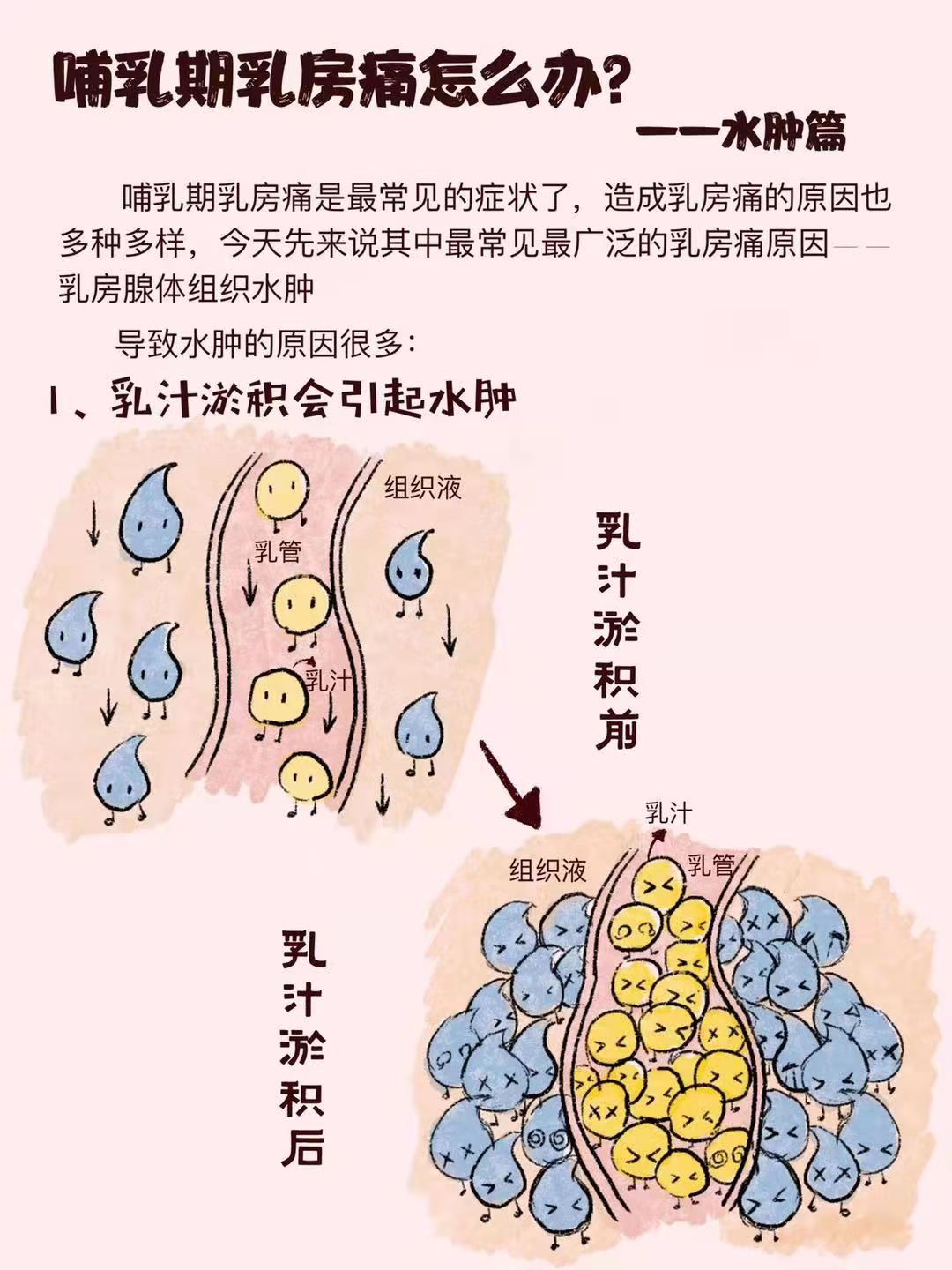 世界母乳喂养周|哺乳期乳房痛怎么办?——水肿篇