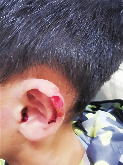 7岁男童被理发师剪破耳朵