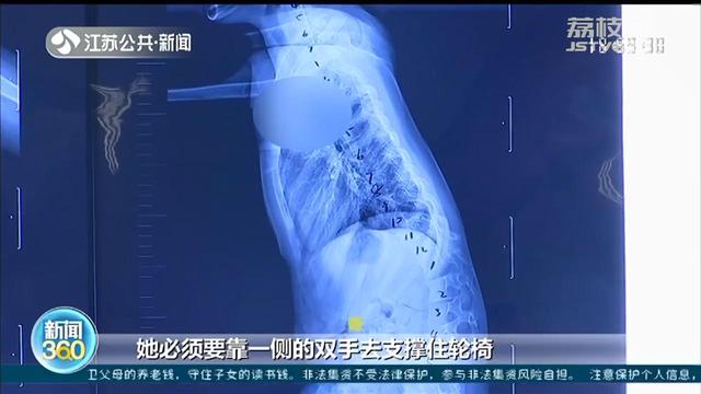 女童5岁时练舞“下腰”导致截瘫 舞蹈梦碎，4年后入院治疗脊柱侧弯休闲区蓝鸢梦想 - Www.slyday.coM