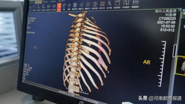 what七岁女孩肋骨凹陷发生了什么