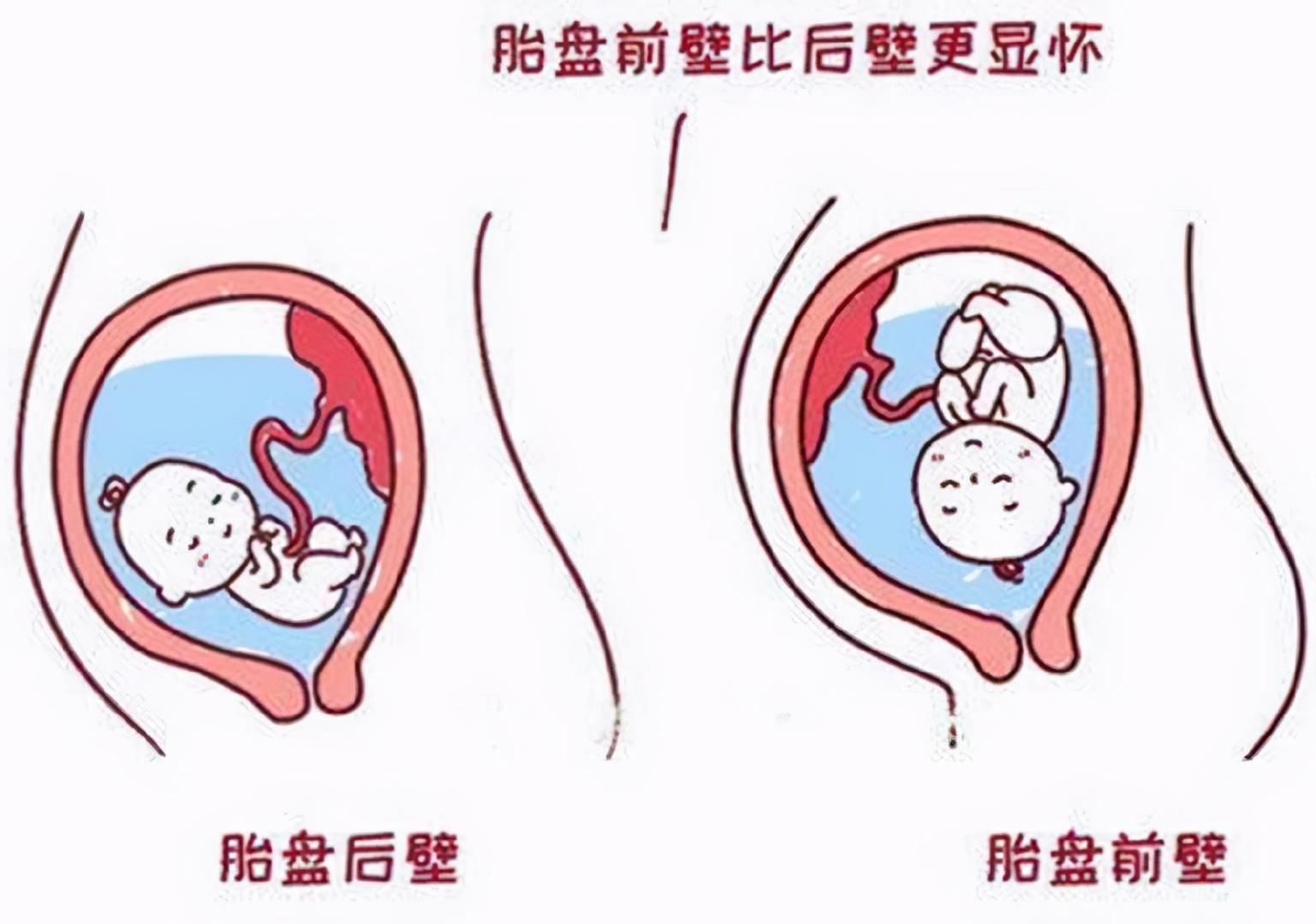 指宝宝的胎盘附着在了子宫靠近肚皮的外面位置,而胎盘后壁则是指胎盘