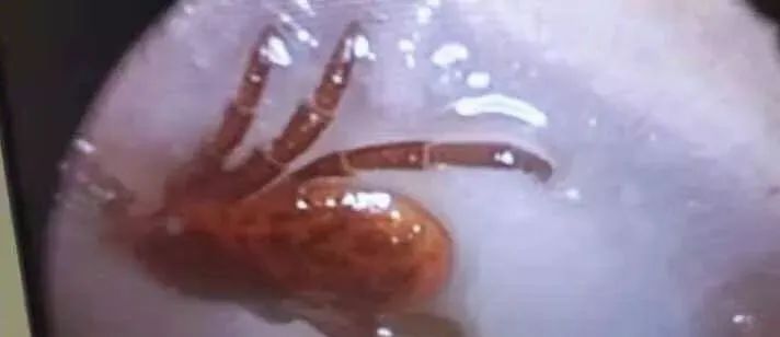 蜱虫为何会使人生病?被叮咬后该如何处理才安全?及时正确取出蜱虫!休闲区蓝鸢梦想 - Www.slyday.coM 蜱虫为何会使人生病?被叮咬后该如何处理才安全?及时正确取出蜱虫!休闲区蓝鸢梦想 - Www.slyday.coM