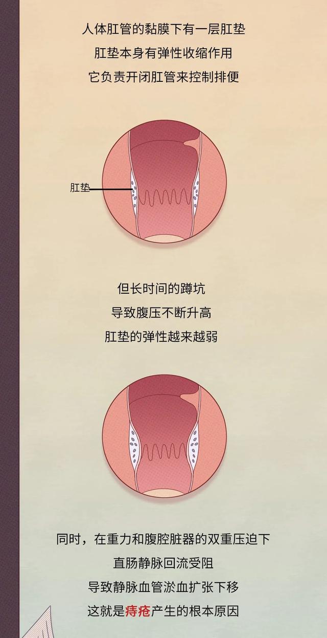 痔疮|肛门|直肠脱垂_新浪新闻