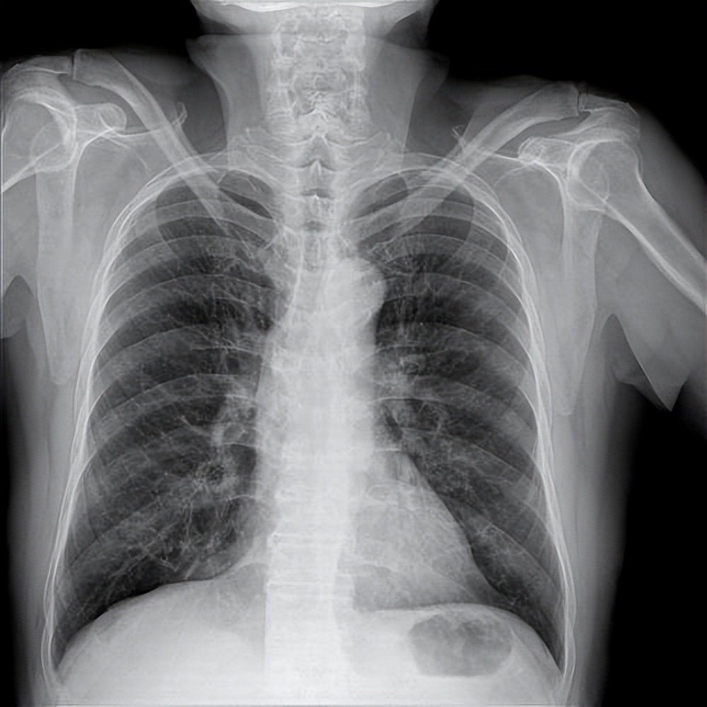 一旦感染新冠病毒,为何要小心"白肺"|肺部|杂质|咳嗽_新浪新闻