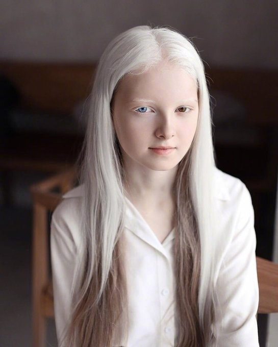 白化病,虹膜异色症.一亿人中才出现一个的奇迹俄罗斯美少女