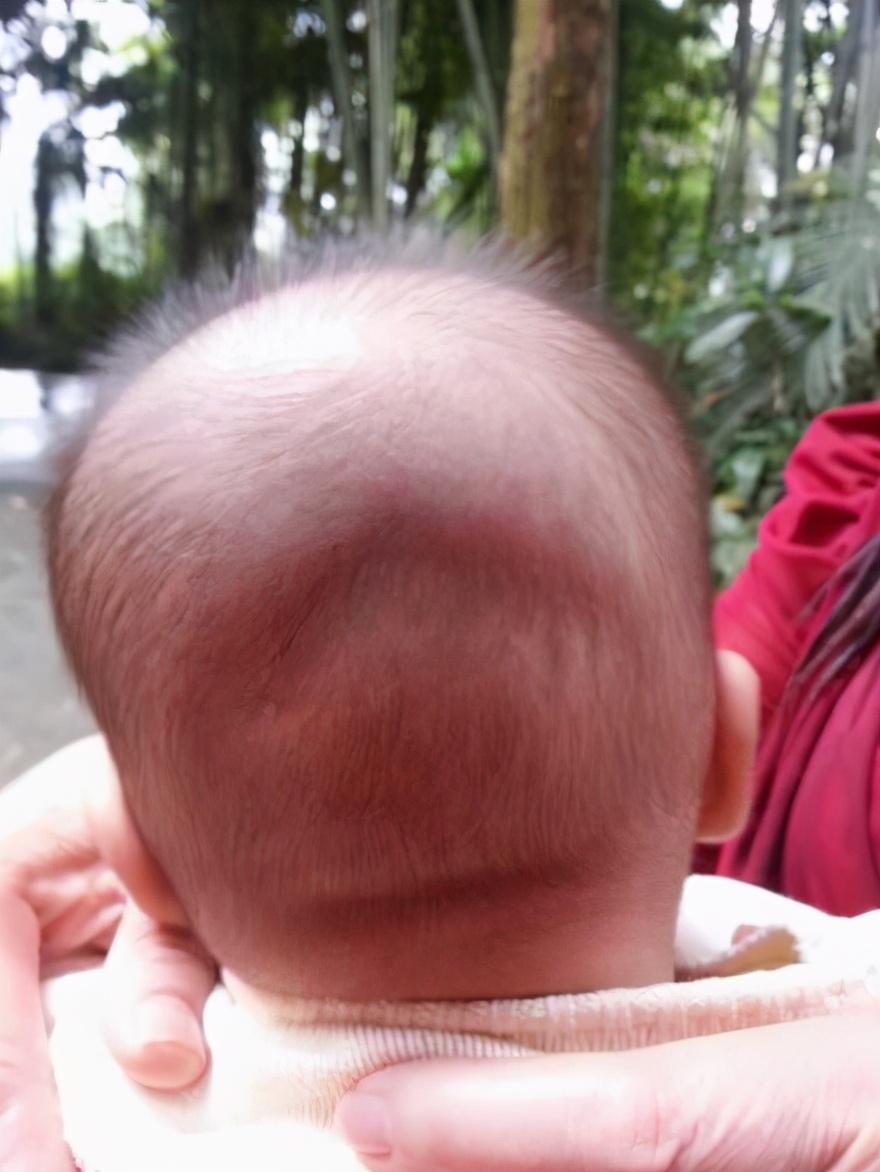 囟门真那么脆弱?