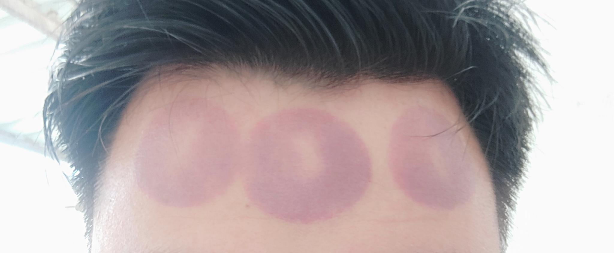 最近总是犯困,然后我那些拔罐给自己额头来了几下_高清图集_新浪网