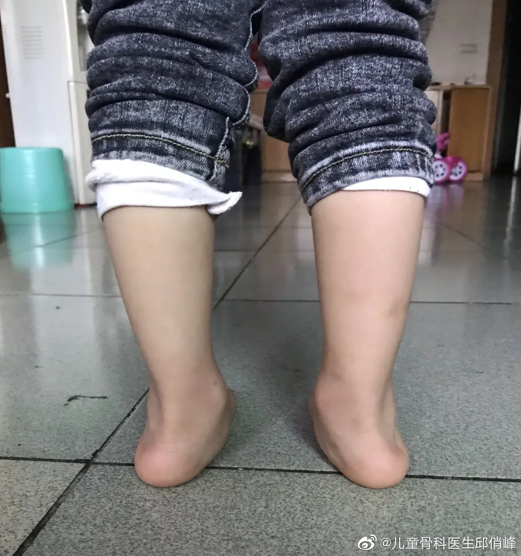 足外翻的石膏纠正,我现在做的比较少了,主要是需要很精细_高清图集