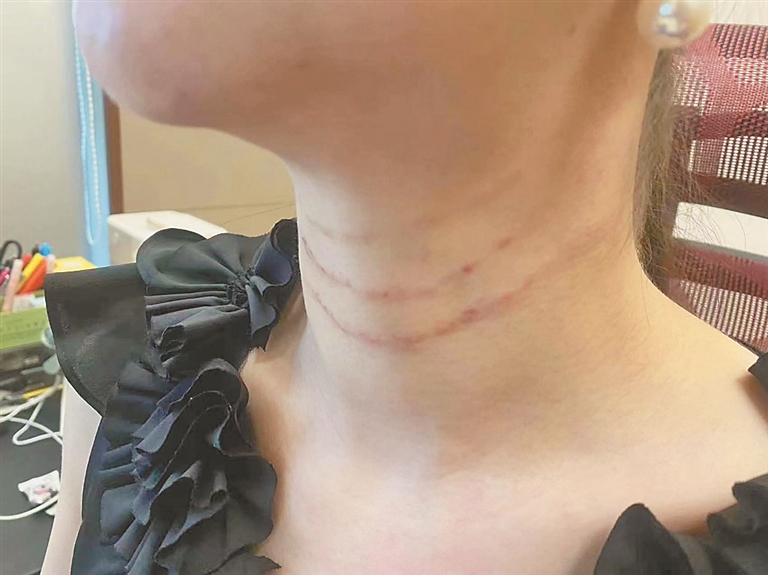 本想美容除颈纹 脖子竟留三道"勒痕"|美容|生活报|医疗_新浪新闻