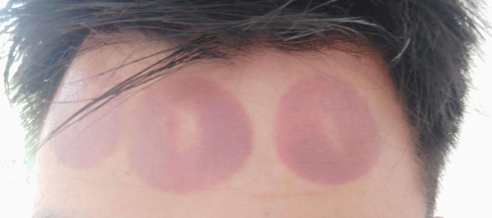 最近总是犯困,然后我那些拔罐给自己额头来了几下__财经头条