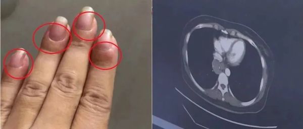 女子手指肿成"萝卜头",一查竟是癌症!