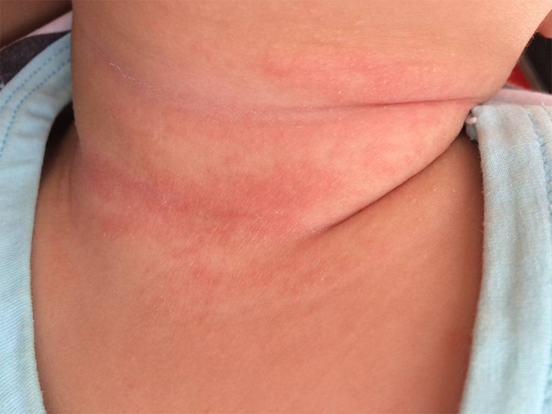 宝宝总是反复起大片湿疹,是胃肠功能弱导致免疫力低下,怎么办?