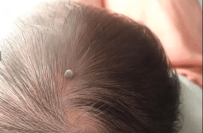 出生仅4天婴儿被蜱虫咬伤，飞虫落身上不要随意拍打休闲区蓝鸢梦想 - Www.slyday.coM