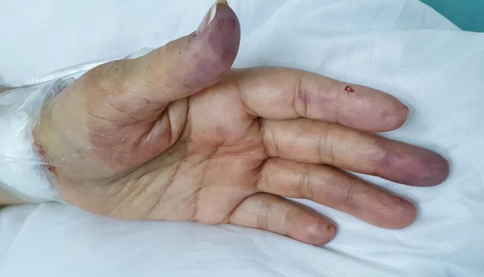 支架术后,你手腕上的创口恢复好了吗?手臂锻炼操来了!