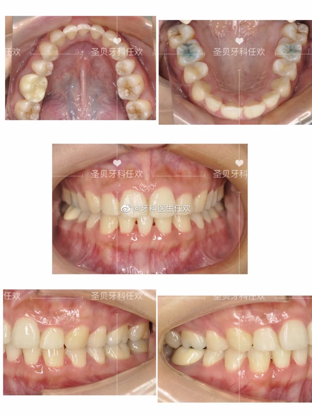 成都牙齿矫正案例, 深覆合下颌先天缺失一颗牙