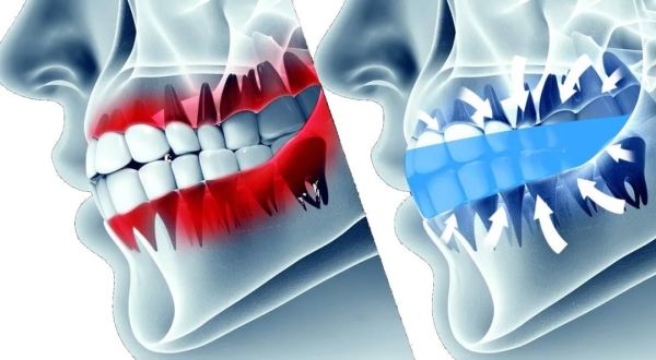 谷爱凌比赛时咬的是什么？运动护齿，守护牙齿的“金钟罩”休闲区蓝鸢梦想 - Www.slyday.coM