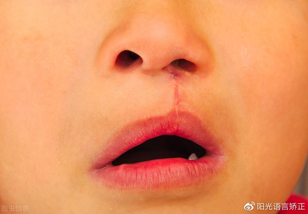 唇腭裂孩子正常说话,分几步?