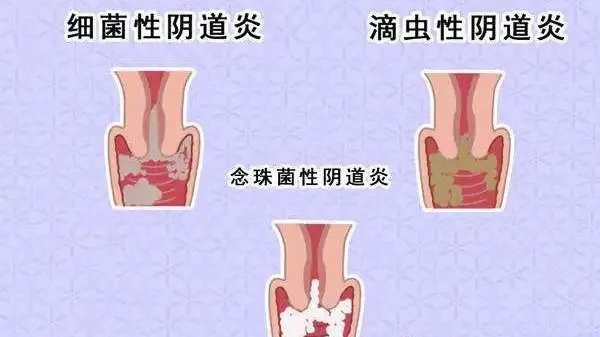 春季妇科炎症又到高发,务必做好这些防护措施|阴道炎|盆腔炎|妇科疾病|妇科病|女性_新浪新闻
