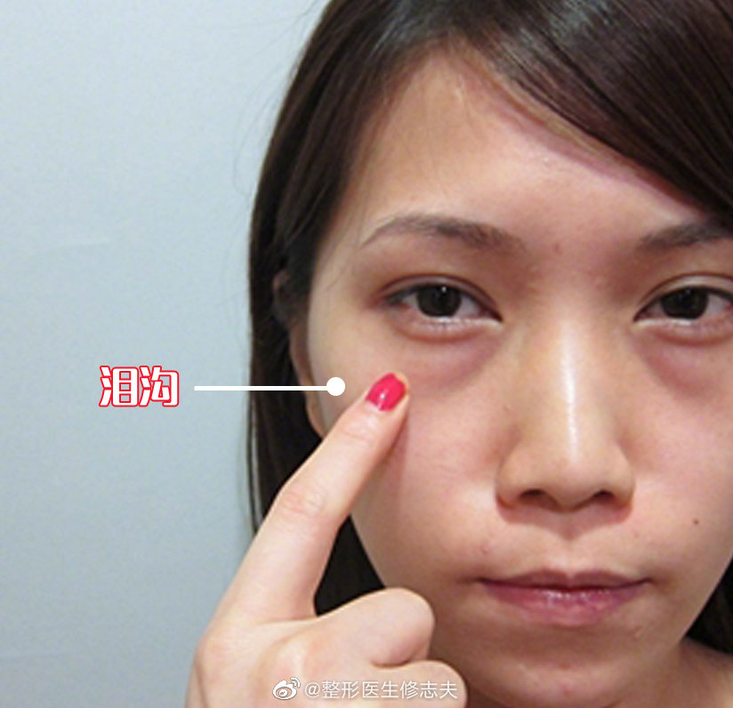 泪沟严重时,会一直从眼角延伸到中面部