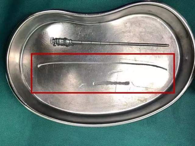 20岁女生脑袋里取出27厘米长的活虫，医生说：和生活饮食习惯有关休闲区蓝鸢梦想 - Www.slyday.coM