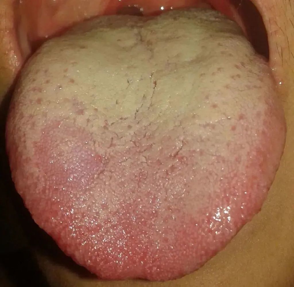 银翘散有辛凉解表,清热解毒的作用,主要缓解的是咽