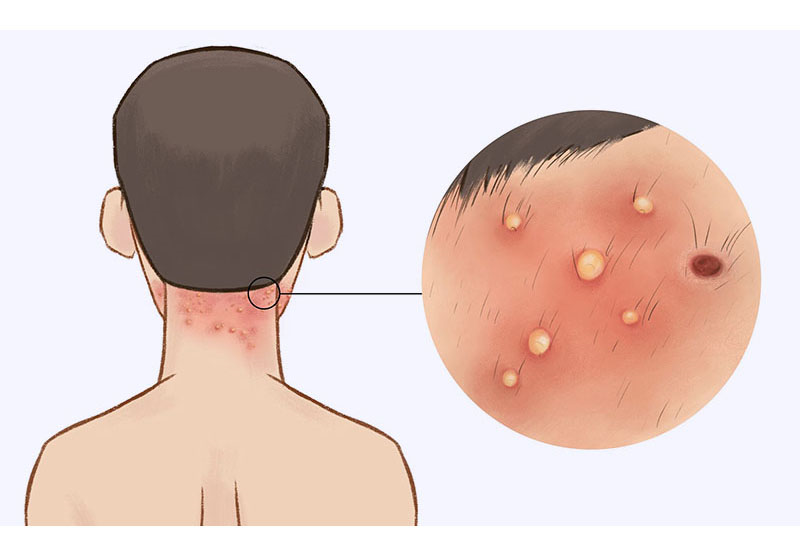 头皮毛囊炎可以自己挤吗?多久才能治好?__财经头条