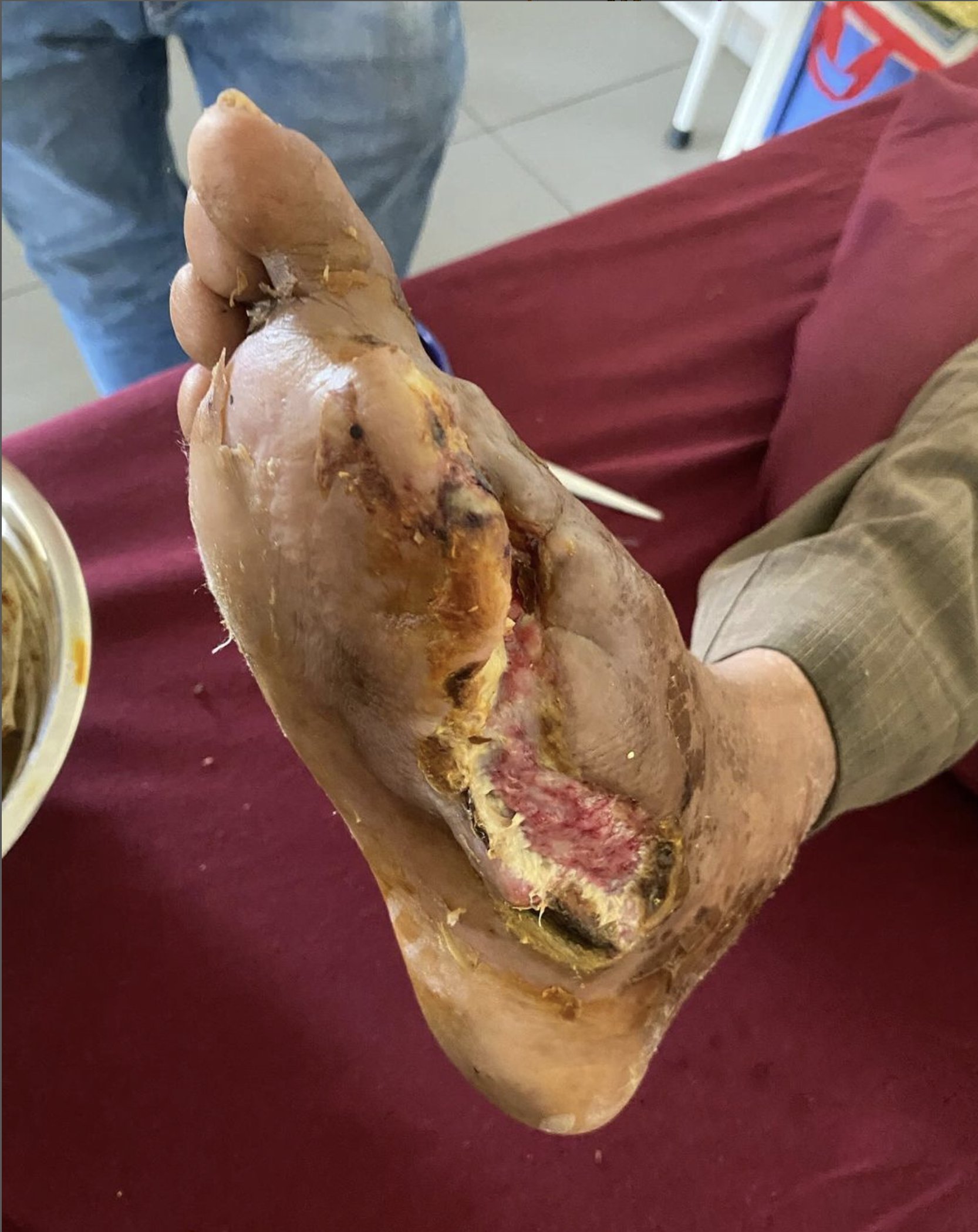 糖尿病足,大脚趾截肢