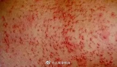 小儿推拿杨晓:炎炎夏日是痱子高发季节,宝宝长痱子如何预防护理|痱子|宝宝|杨晓_新浪新闻