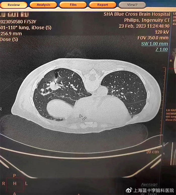 做增强CT 和 心脏血管狭窄 说明病情严重吗