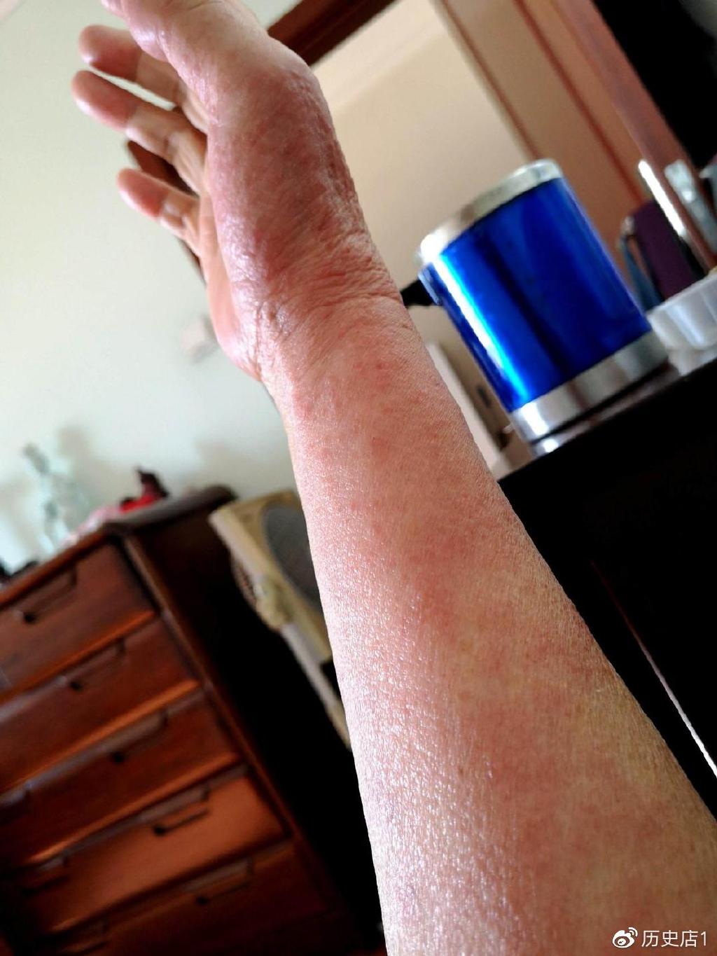 从专业的医学角度来看,由漆树漆酚引起的过敏反应又称为Ⅳ型超敏反应.