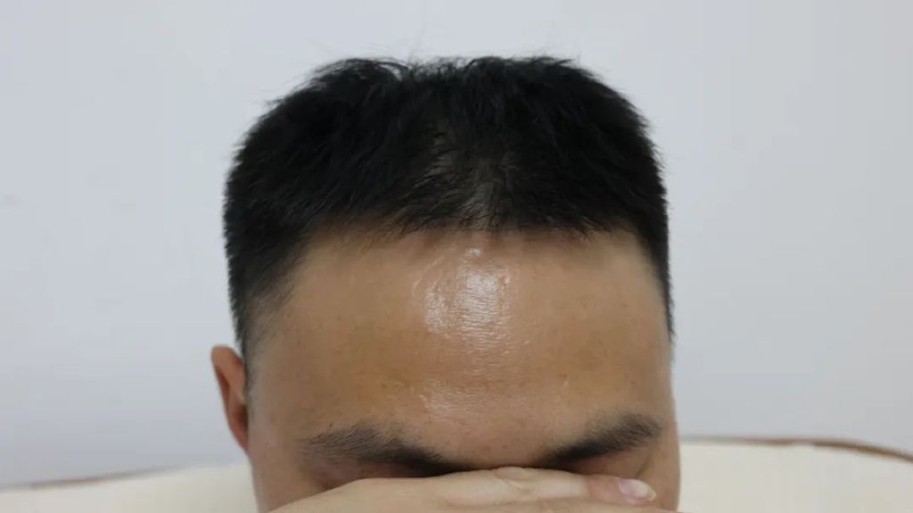 最先出现在两鬓,前额和后脑勺,那么大家知道当白发出现在这些位置时