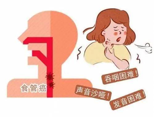 草原王爷专业户陨落食管癌在我国高发到什么程度如何预防