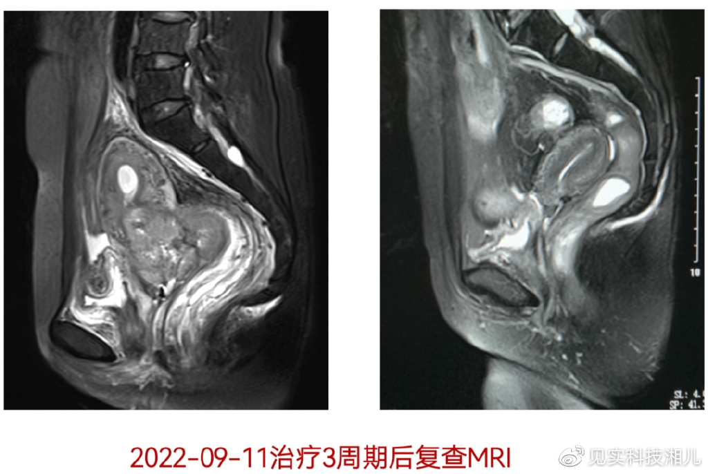 复发/晚期宫颈癌的个体化免疫治疗两例病例分享__财经头条