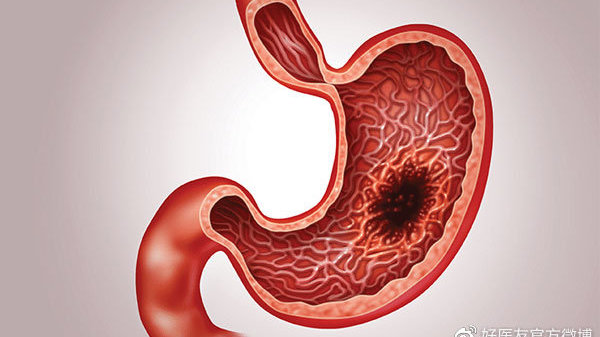 得胃癌主要是什么原因引起的 幽门螺杆菌与胃癌饮食关系大揭秘