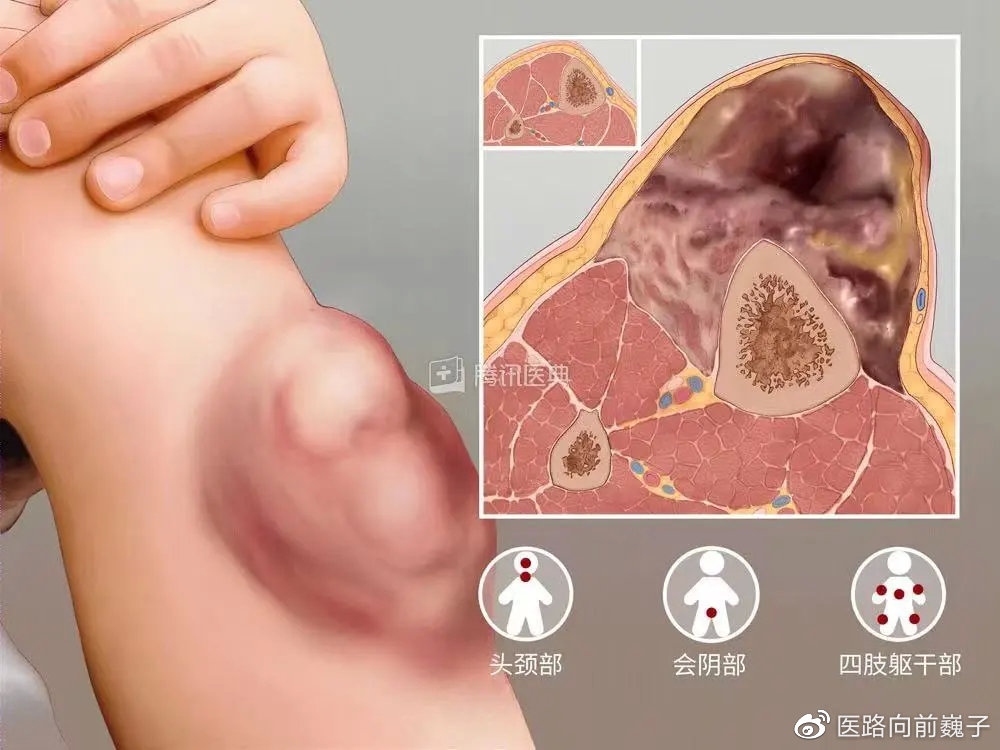 上海市|横纹肌肉瘤_新浪新闻