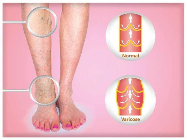 血栓是拖出来的腿脚出现3种信号是血管堵塞症状不能拖