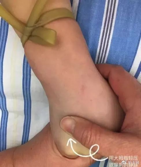 用大拇指轻按穿刺的静脉,近心端向远心端轻按,推行 3～5 cm,再由远心