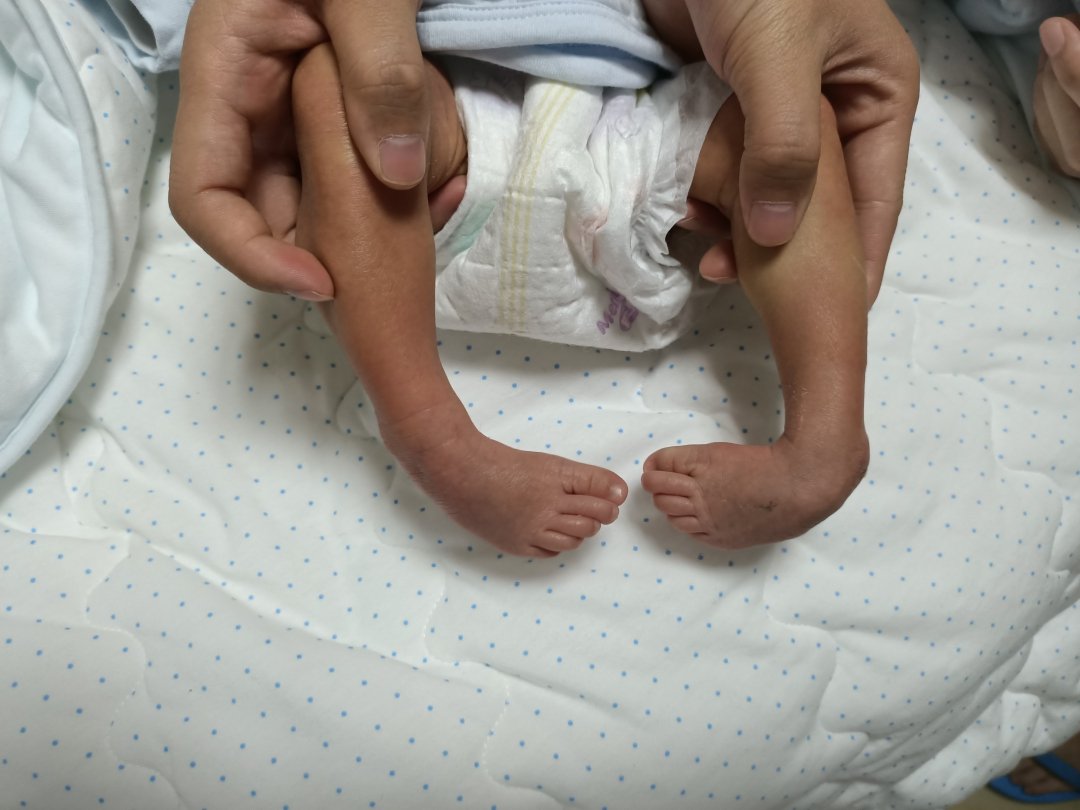 若孕妇睡姿不对可挤压胎儿腿部,使得胎儿足部不能自然伸展,因为足部