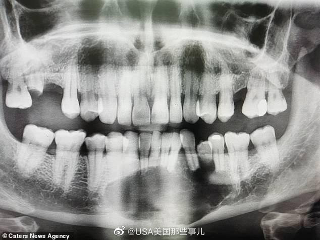 英国一名51岁男子由于害怕看牙医,27年来都没去看牙