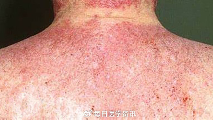 65.慢性光化性皮炎-物理性皮肤病|皮炎|皮肤病_新浪新闻