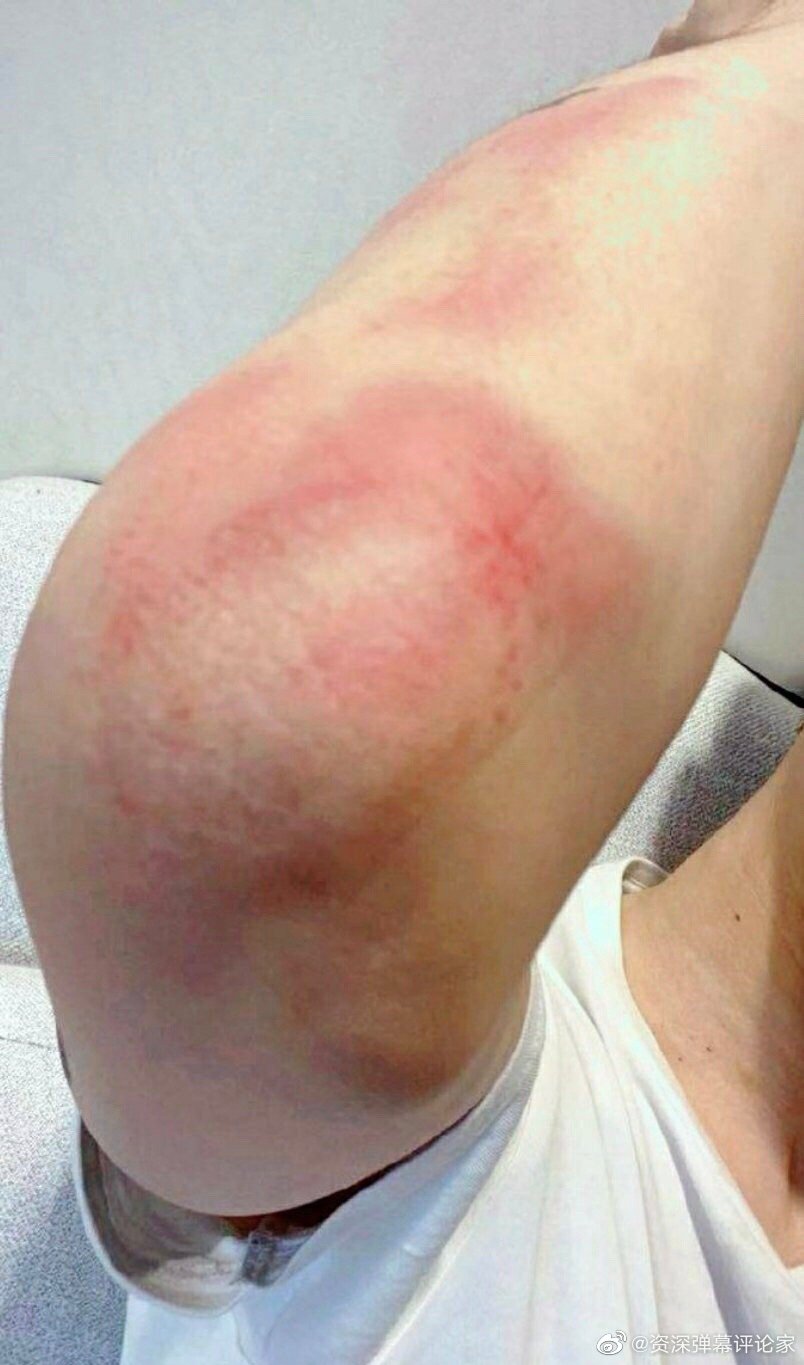 范丞丞在拍《左肩有你》时候胳膊受伤了