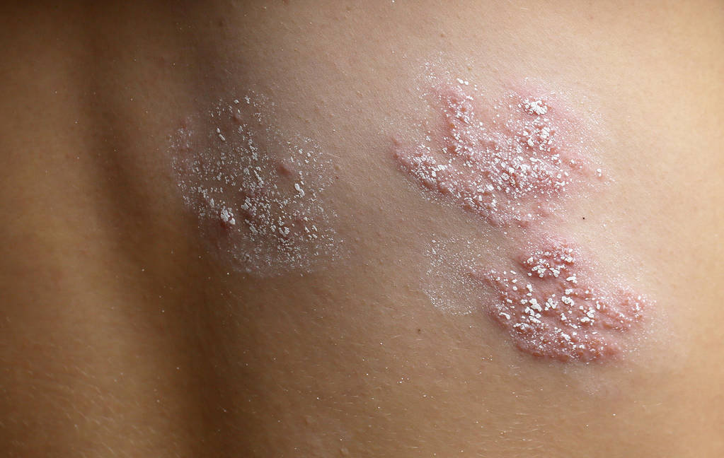 男子自知艾滋病感染仍嫖男娼如何识别对方是否是艾滋病患者