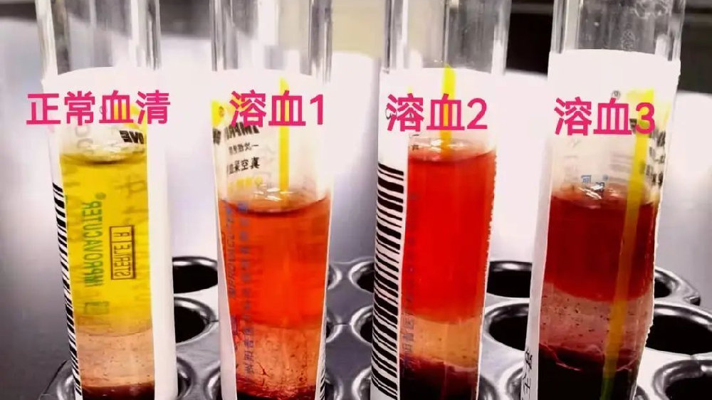 需要重新采血？揭秘检验科关于溶血那些事儿|检验科_新浪新闻