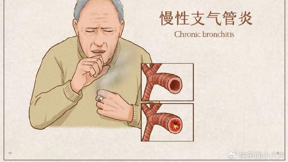 远离慢性支气管炎,这些错误认知不要犯！做好正确治疗！|呼吸道感染|反复呼吸道感染|肺部疾病|呼吸系统疾病|感染_新浪新闻
