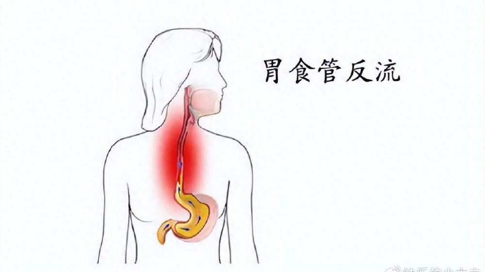 长期出现这些症状，可能胃食管反流引起的，这几类高发人群要注意|胃部疾病|胃食管反流病|食道|手术|饮食_新浪新闻