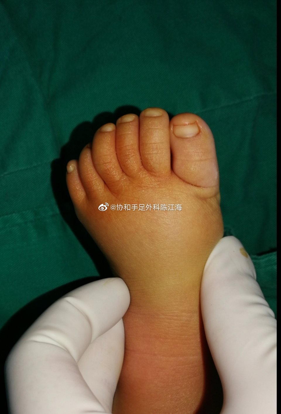 这是位双足多趾宝宝,但是宝宝妈妈术前很犹豫,她咨询过很多医生