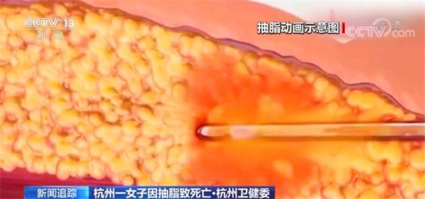 怎么追求美？杭州一女子因医疗事故抽脂致死亡 热点问题解析休闲区蓝鸢梦想 - Www.slyday.coM