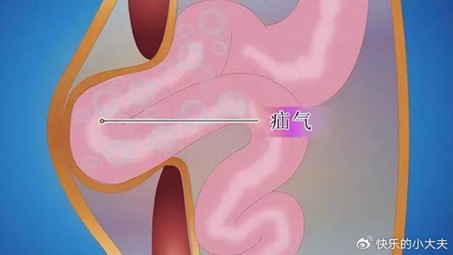 疝气是怎么回事?对身体有哪些危害?需要手术吗?|腹腔|腹股沟疝|修补术|腹壁|便秘_新浪新闻