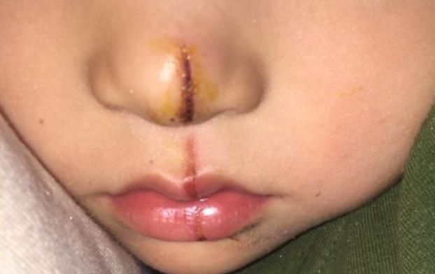 宝宝的鼻梁何时"定型"?塌鼻梁的娃想"逆袭",要满足哪些条件